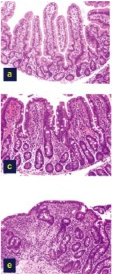 Celiac-Disease-Damage